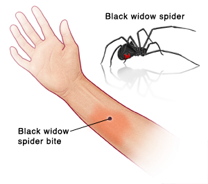 Black widow spider bite on arm, with picture of black widow spider.