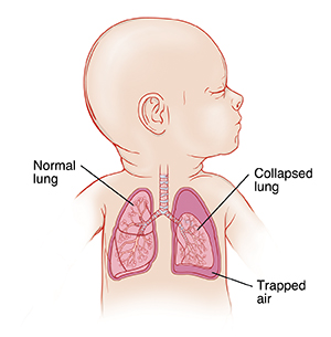 Closeup of baby showing airway and lungs, with one collapsed lung with trapped air around it.