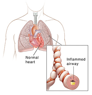 In the lungs, inflammation of the airway causes bronchiole asthma.