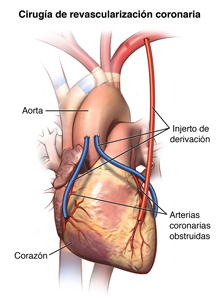 El corazón y la parte de la arteria coronaria donde se realiza el injerto